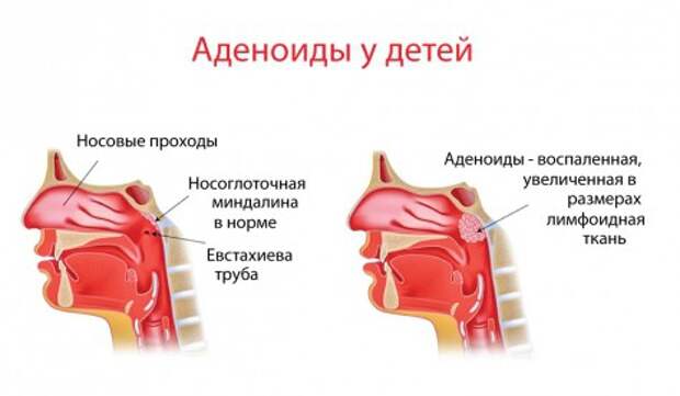 Аденоиды у детей: симптомы, лечение.
