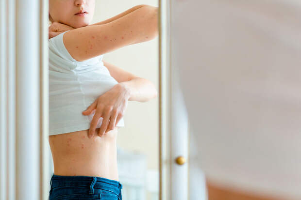 PNAS: воспаление при псориазе подавляет развитие рака кожи