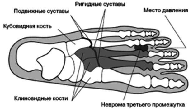 Где плюсневые кости. Зоны плюсневой кости стопы. Периостит плюсневых костей. Периостит плюсневых костей стопы.