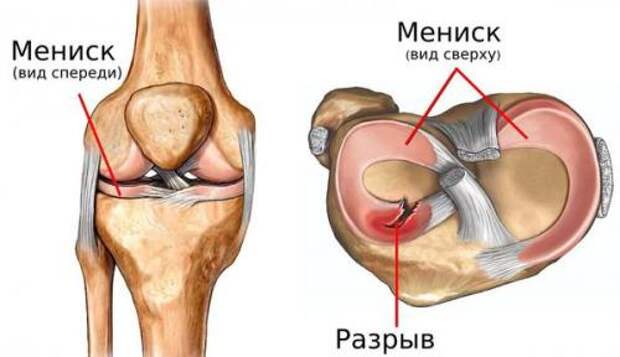 Разрыв мениска продольный. Разрыв мениска: причины и ход заболевания 04