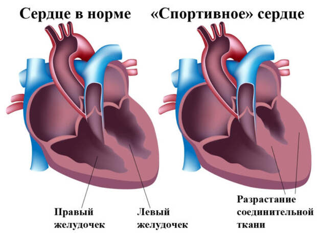 Схема сердца в норме и патологии Спортивное сердце