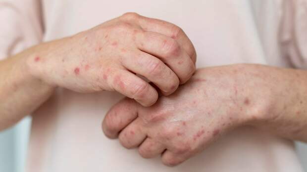 Оспа обезьян проникает в Россию: подтвержден случай заражения, еще один — под вопросом