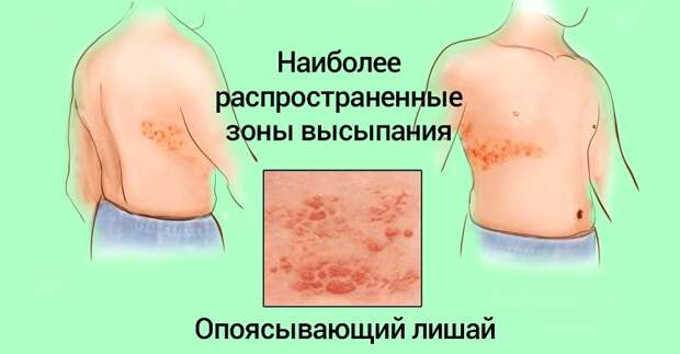 опоясывающий лишай лечение