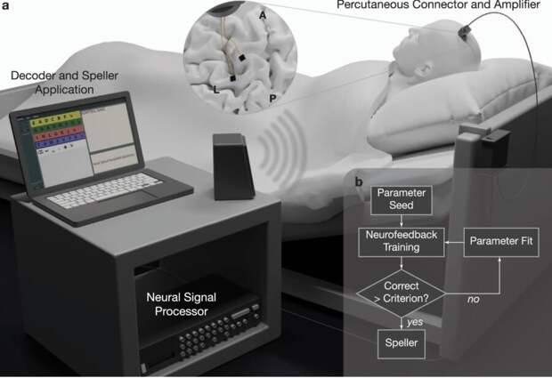 brain implant