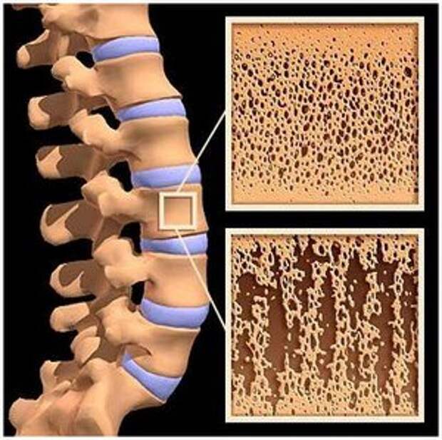 Остеопороз, симптомы и лечение