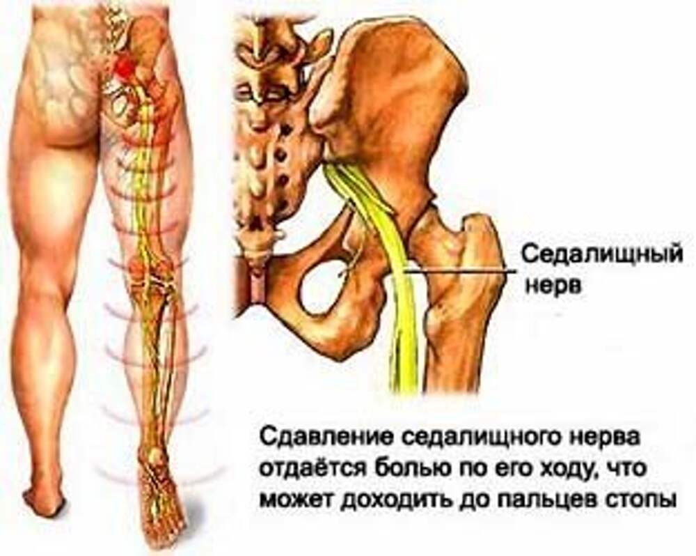 Седалищный нерв боль в ноге и ягодице
