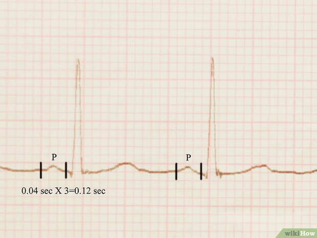 Изображение с названием Read an EKG Step 3