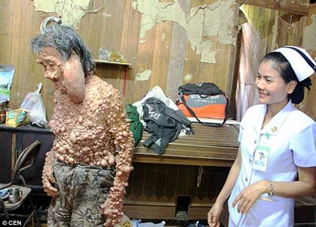 Обезображенный отшельник появился на публике впервые за 45 лет, чтобы почтить память короля азия, нейрофиброматоз, отшельник, тайланд