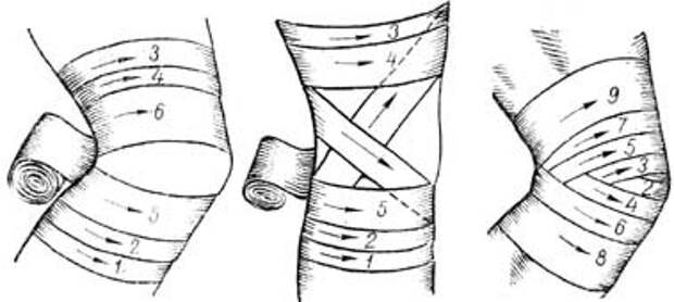 Черепашья повязка бинтом фото Медтехника