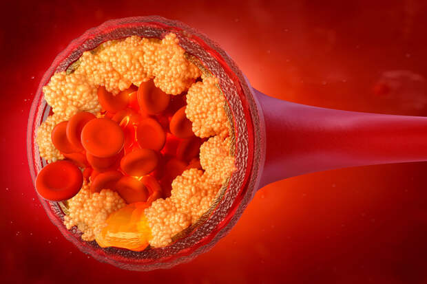 Lancet: большинство побочных эффектов статинов не подтвердилось