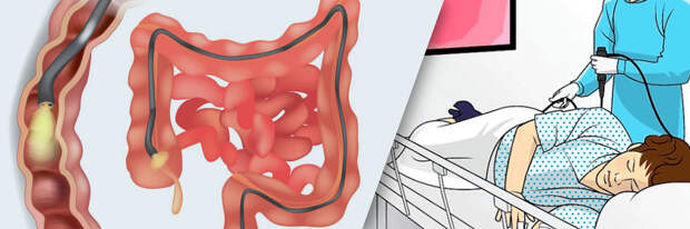 Может ли колоноскопия быть причиной панкреатита?
