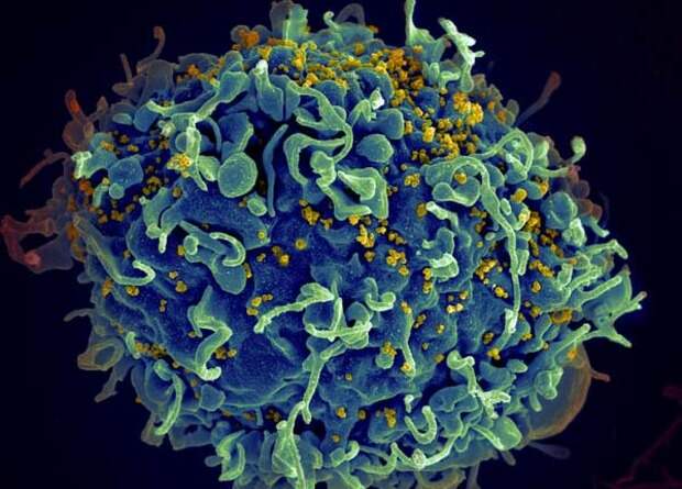 У второй ВИЧ-инфицированной пациентки заподозрили естественное избавление от вируса