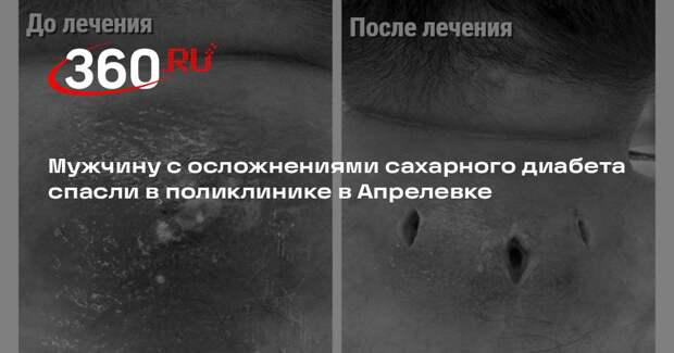 Мужчину с осложнениями сахарного диабета спасли в поликлинике в Апрелевке