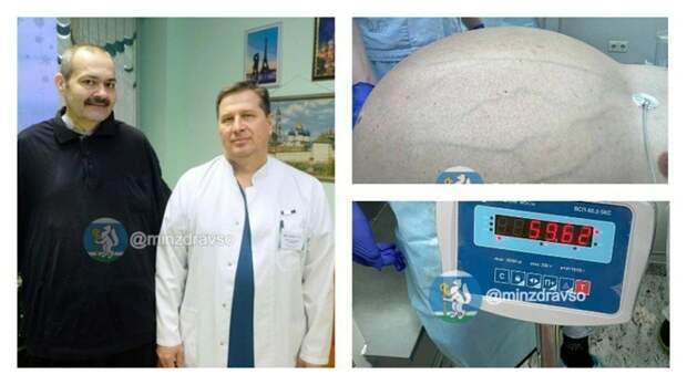 На Урале врачи вырезали из живота пациента гигантскую опухоль весом 60 кг