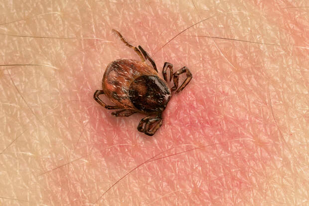 Перечислены признаки заражения после укуса клеща