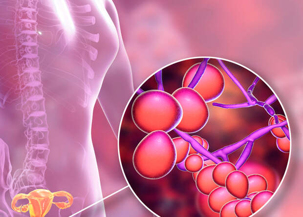 Как избавиться от кандидоза без медикаментов за 3 шага
