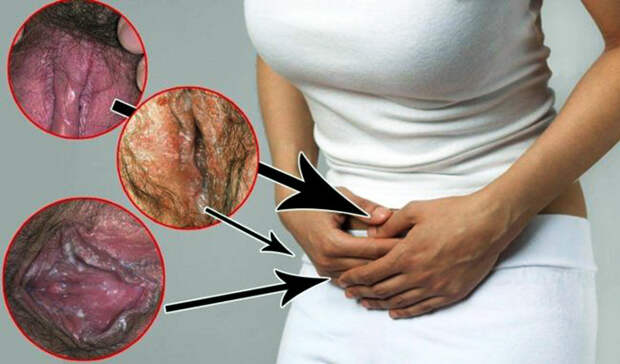 "Доктор, у меня чешется": Почему израильские гинекологи не спешат ставить диагноз "молочница"