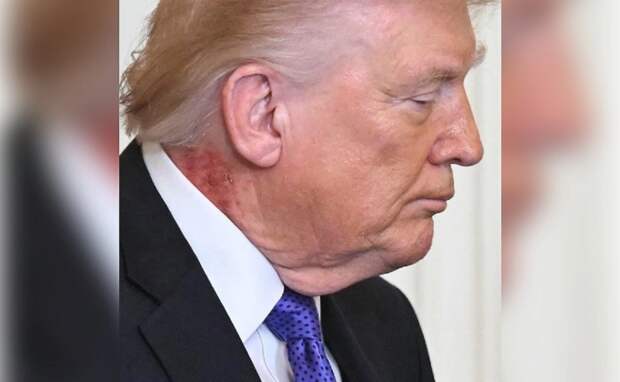 У Трампа заметили странное красное пятно на шее