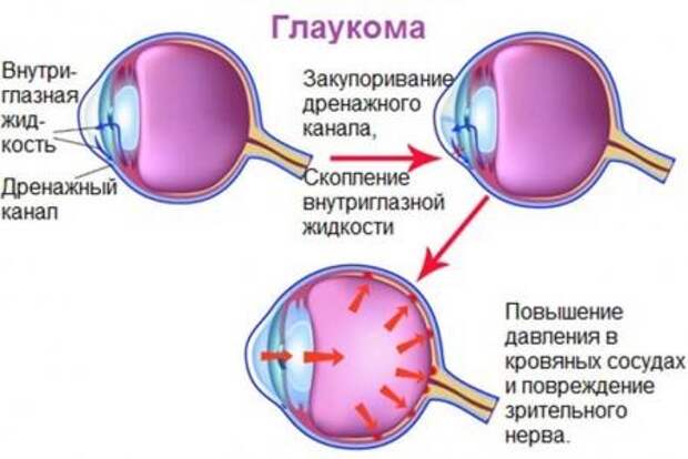 Глаукома (449x300, 22Kb)