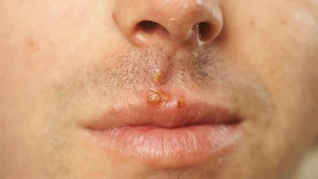 Герпес на губе: почему возвращается и как лечить