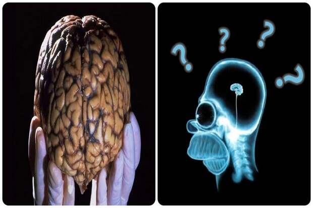 Может ли человек выжить без мозга?