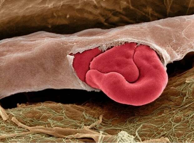 А это - поврежденный капилляр с красными кровяными тельцами внутри