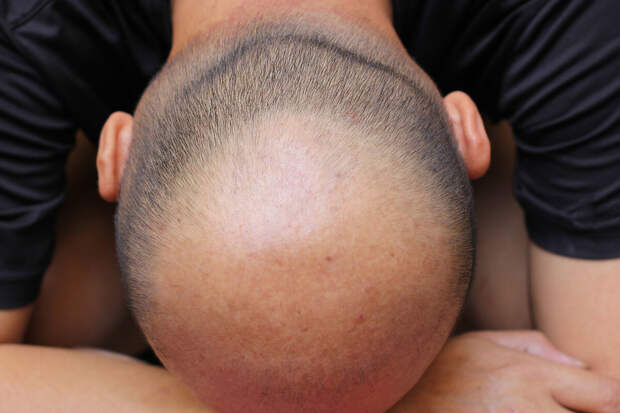 В Саратове мужчина чуть не облысел после покупки средства для волос