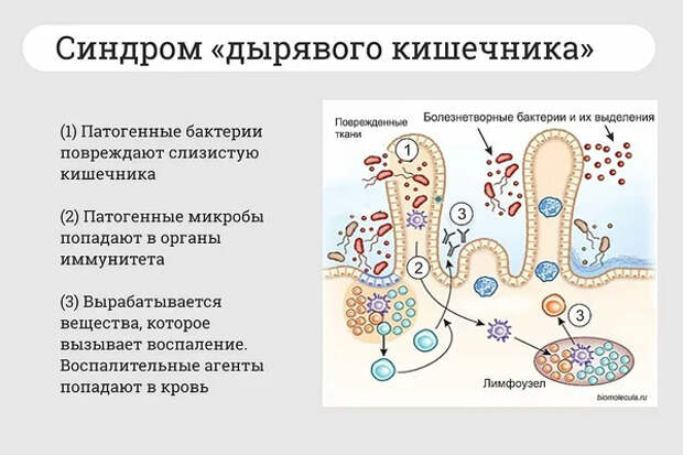 Синдром дырявого кишечника  - диагноз 21 века