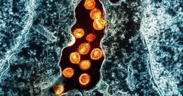 Норвежец избавился от ВИЧ после пересадки стволовых клеток брата с мутацией CCR5