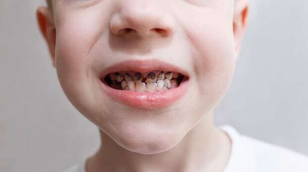 Кариес молочных и постоянных зубов встречается у почти у 80% детей