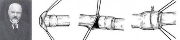 Бесшовное соединение сосудов метод а г коневского. Механический шов сосудов сшивающими аппаратами Гудова.