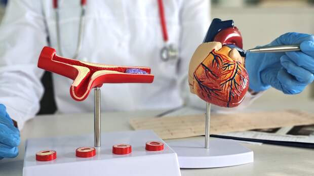 Врач рассказал о скрытых последствиях атеросклероза: эта болезнь может лишить ног, привести к импотенции и инсульту