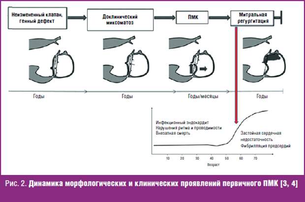 Дегенерация митрального клапана