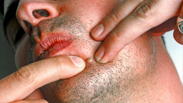 Не просто прыщ: почему опасно трогать фурункулы