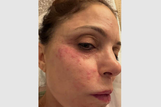 Телеведущая заразилась инфекцией в отпуске из-за отельного полотенца