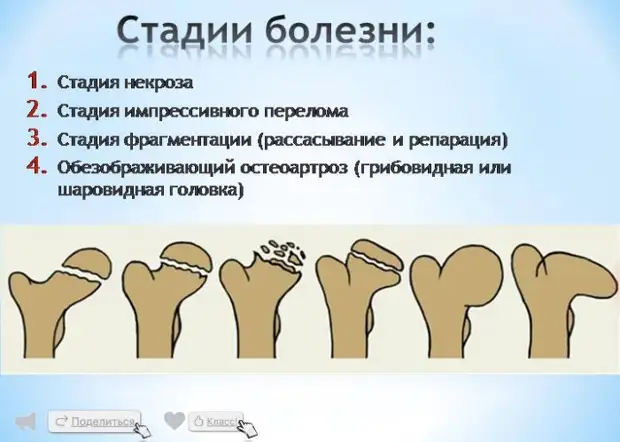 Асептический некроз головки мкб 10. Остеонекроза головки бедренной кости. Степени асептического некроза головки бедренной кости на кт. Асептический некроз головки бедренной кости 3 стадии. Асептический некроз головки бедренной кости 1 стадии.