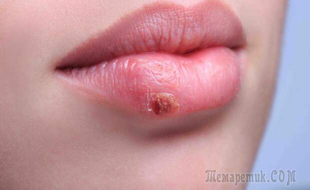 Прыщи на губах: причины, лечение