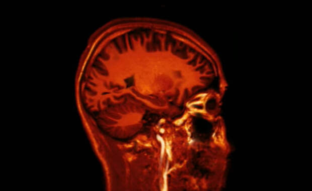 Деградация мозга Кроме того, спячка могла бы повредить и мозгу в целом. Исследование Леона Балцига из университета Валтoрны, Пенсильвания, однозначно показало деградацию синапсов, соединяющих нейроны мозга. Сконструированная компьютером модель человеческого разума продолжала показывать ухудшение работы даже после выхода из спячки. Спустя два месяца «пробуждения» условный человек превратился бы в безмозглый овощ.