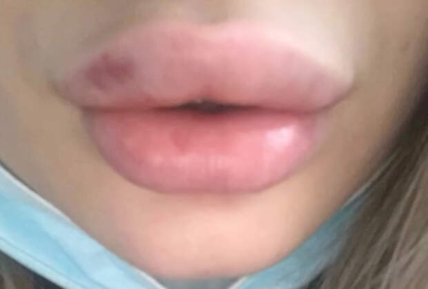 Российская блогерша навсегда осталась с утиными губами из-за филлеров