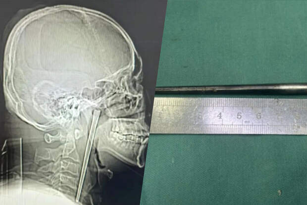 Mothership: китаец 8 лет прожил с 12-сантиметровой палочкой в горле