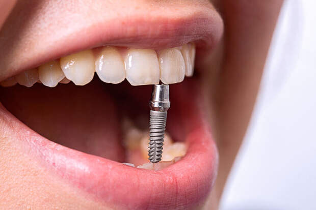 Имплантация зубой и из виды | Стоматология Багита