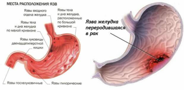 Первые признаки язвы желудка, которые нельзя игнорировать