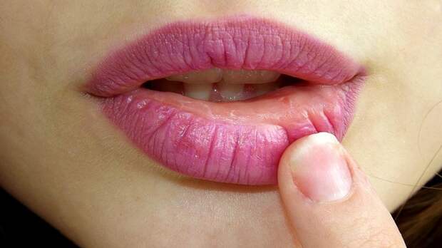 Дерматолог Константинова: сухость губ может указывать на проблемы с ЖКТ и анемию