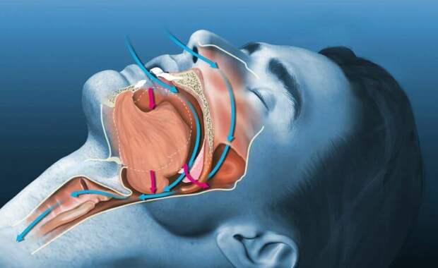 Из-за чего люди храпят. Храп возникает из-за расслабления мягких тканей в области горла. Фото.