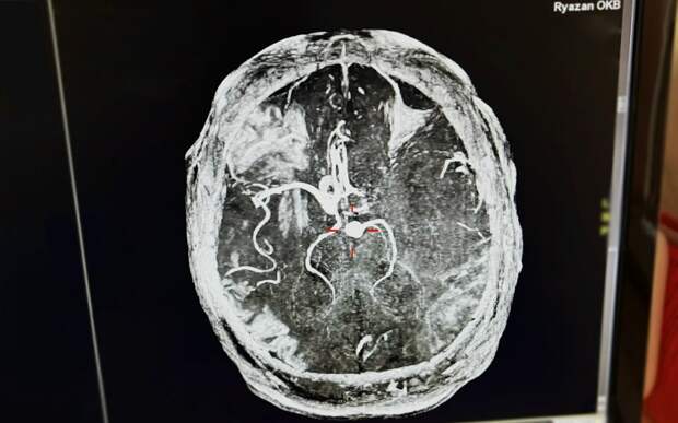 Пил по 8 банок энергетика: врачи чудом спасли 43-летнего рязанца с инсультом