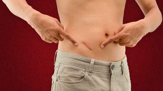 Зачем нужен аппендикс и почему его зря считали бесполезным