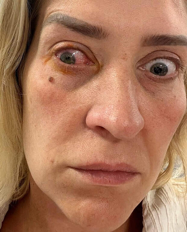 Daily Mail: британка не снимала линзы 2 недели и временно ослепла на один глаз