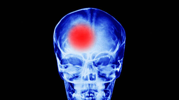 Невролог Жарова: признаки инсульта не всегда очевидны