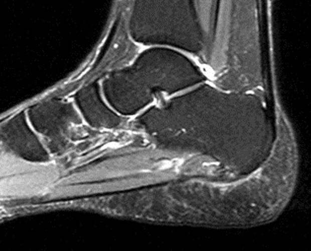 МРТ при плантарном фасците: показания и значение