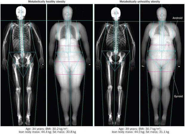 Как различить здоровый и нездоровый избыток массы тела